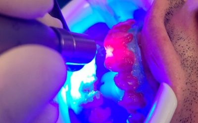 Sbiancamento dentale e Inestetismi