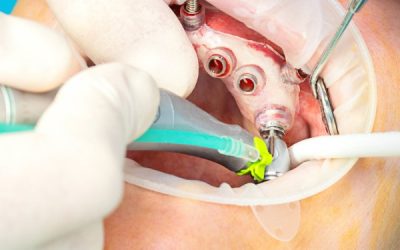 Chirurgia e Implantologia