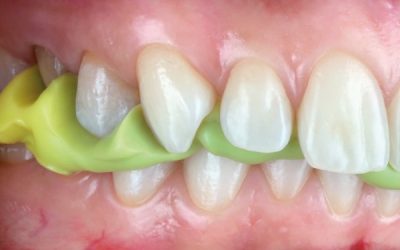 Riabilitazione Occlusale